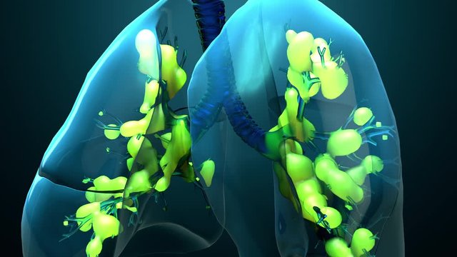Damage lungs, severe respiratory illness, pneumonia, ARDS, acute respiratory distress syndrome caused by the coronavirus