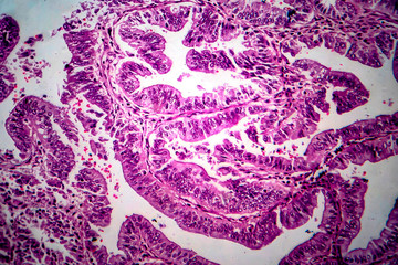 Endometrial adenocarcinoma, light micrograph, photo under microscope
