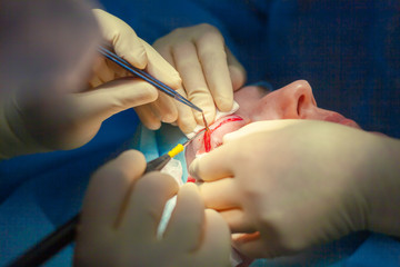 Obraz na płótnie Canvas Close up of surgeons hands performing an incision on the upper eyelid of the patient starting the blepharoplasty operation