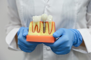 dental concept. the hands of a dentist doctor hold a model of teeth with a dental implant 