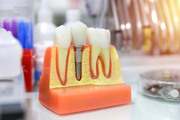 model of human tooth implant is on dentist's table close up