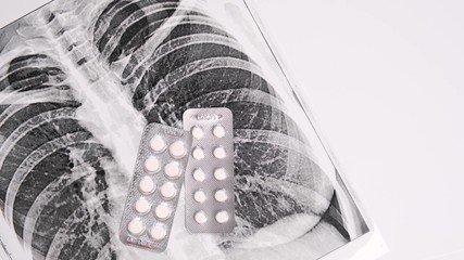 Fluorography, x-ray and different pills in blisters falling on it on white background, pneumonia...