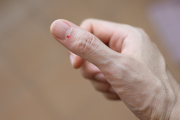 Injured finger with bleeding open cut