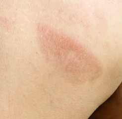 Fototapeta premium Bruise on human skin as a background.