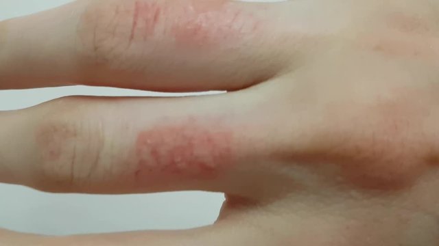 Severe dryness and redness on the female hand. Skin damage after using chemicals. Allergic reaction