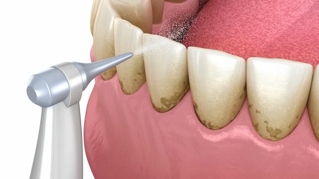 Oral hygiene: Air flow water Teeth Cleaning. Medically accurate 3D animation of human teeth treatment