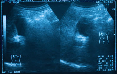 Whole abdomen ultrasound scan.Human film x-ray image. Radiology image for medical treatment.