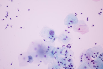 View in microscopic of Abnormal human cervical cells.Squamous epithelium cells.Superficial and intermediate epithelial cells.Cytology and pathology laboratory department.Magnification 600 X