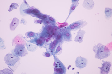 Fototapeta premium Image from microscopic of herpes simplex virus infection show ground glass appearance criteria in human cervical pap smear slide.Cytology and pathology diagnosis for skin infection disease concept.
