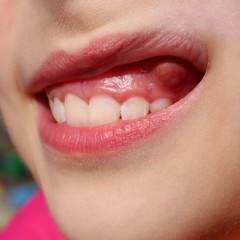 Swelling on gums the child.