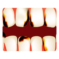 Dental caries. tooth decay. Caries infographics. Vector illustration on isolated background.