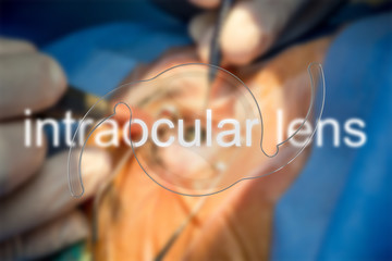 intraocular lens iol cataract ophthalmology