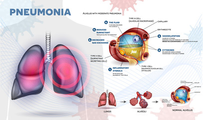 Pneumonia explained info poster, body immune response, human lungs and detailed alveolus anatomy illustration.