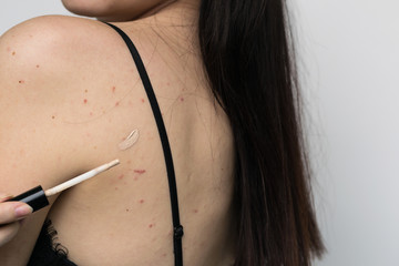 problematic skin of the back and face of a young girl, an attempt to gloss over with a corrective...