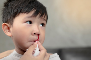 Portrait of cute Asian ethnic child having nosebleed,The concept of first aid for nosebleeds.