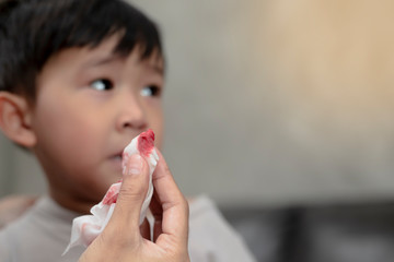 Portrait of cute Asian ethnic child having nosebleed,The concept of first aid for nosebleeds.