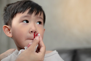 Portrait of cute Asian ethnic child having nosebleed,The concept of first aid for nosebleeds.