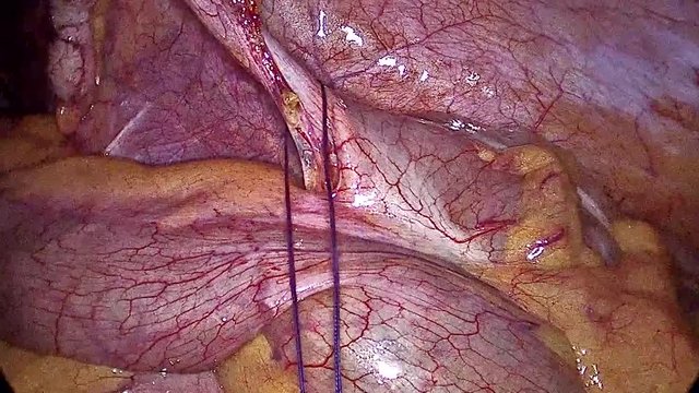 Appendicitis Surgery. View from the surgical camera of the process of removing Appendix_part06