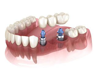 Dental bridge supported by implants. Medically accurate 3D illustration of human teeth and dentures concept