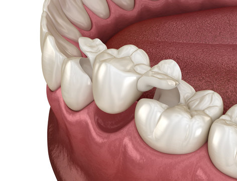 Maryland bridge made from ceramic, premolar tooth recovery. Medically accurate 3D illustration of dental concept