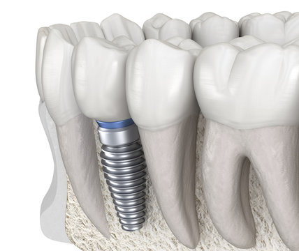 Premolar tooth recovery with implant. Medically accurate 3D illustration of human teeth and dentures concept
