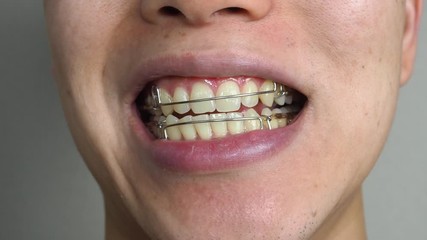 Man opening mouth, and showing dental retainer