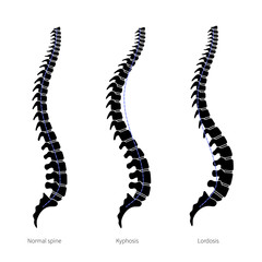 Kyphosis, lordosis flat vector illustration.