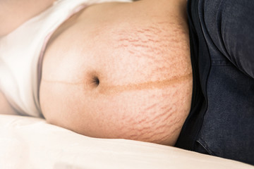 close up stretch marks on pregnant  belly - 347833001