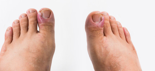Close up of ingrown toenail is Inflamed fingernails isolated on white background. Health care and Foot disease concept