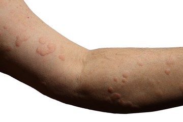 Urticaria on arm of a man over white isolated background.