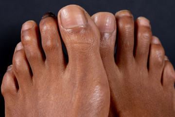 Hammer toe on the second toe of a mixed-race woman in front of black background. Concept for...