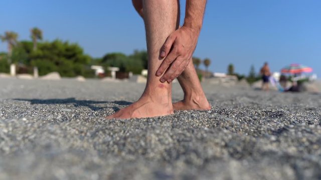 Male's hand scratching leg at the beach, barefoot man staying on pebble shore and touching his leg with jellyfish injury. Male feeling itchy, bite of fish in the water. Leg's inflammation on summer