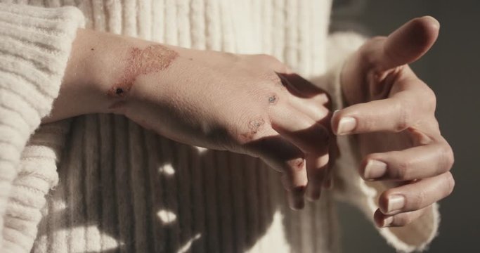 Woman apply ointment antiseptic cream on wounds bruises after accident or domestic violence physical abuse on her hands close up