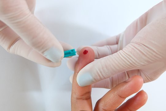 Close up hand wearing white gloves  of a nurse or doctor or technician  holding needle punch  finger patient   blood sample storage at fingertips to determine blood with small drop of blood.