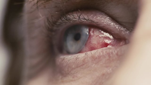 Old Woman's Swelling Infected Eye After Cataract Surgery - Extreme Closeup Shot