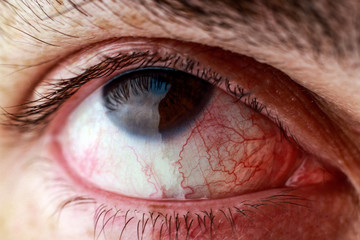 Looking up eyeball and red blood vessels. Eye diseases and dramatic feelings. Part of set.