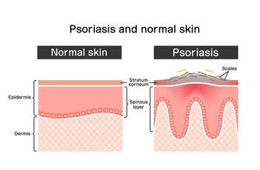 Cross section of psoriasis and normal skin / flat vector illustration