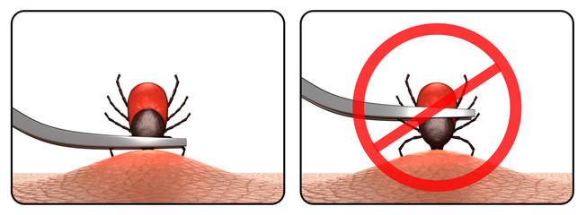 The correct way to remove a tick with forceps. 3D-rendering.