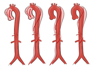 Aortic dissection. Ilustration of four types of aortic dissection
