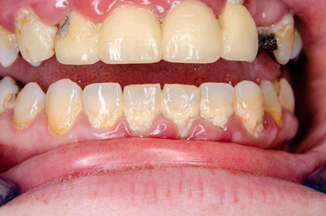 massive plaque and inflammation
