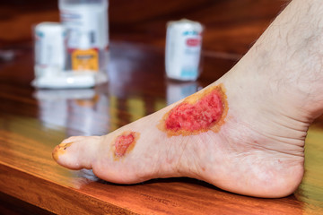 Fresh blood blisters on women's feet,reflection and side effect from motorcycle accident lesion injuries