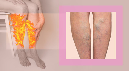 Varicose veins on a legs of old woman on pastel.