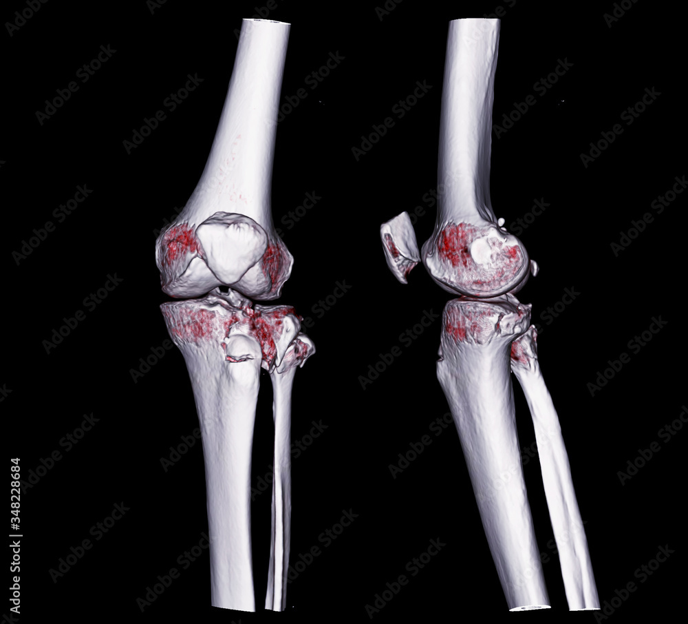 Poster ct knee 3d rendering image ap and lateral view isolated on black background .