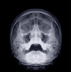  Skull x-ray image of Human skull  water's view for demonstrate facial bone isolated on Black Background