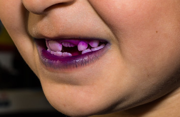 Fototapeta premium Dental plaque pill to indentefy teeth plaque. Blue colour shows plaque less than 24 hour old and purple shows plaque more than 24 hour old.