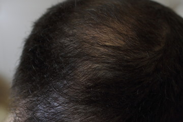 hair loss, man scalp, baldness closeup