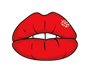 herpes lips