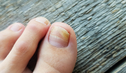 Close-up of a leg with a fungus on nails on a wooden background.