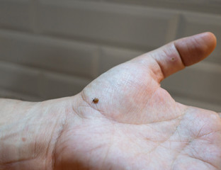 Tick filled with blood crawls across the man's palm. Mite on hand carrier of encephalitis
