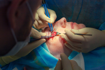 Close up of the face of a patient who is undergoing blepharoplasty. The surgeon cuts the eyelid and performs manipulations using medical instruments